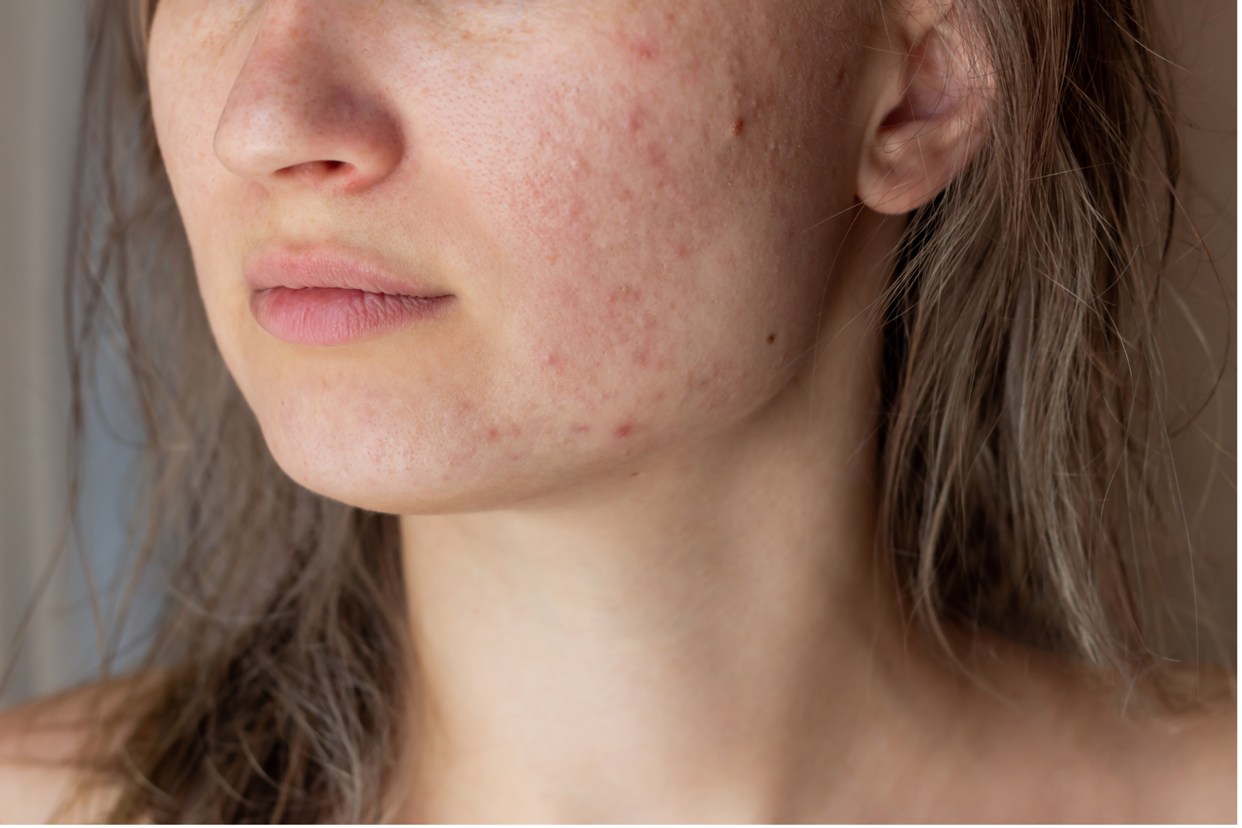 The Real Reason Behind Acne You Probably Didn’t Know